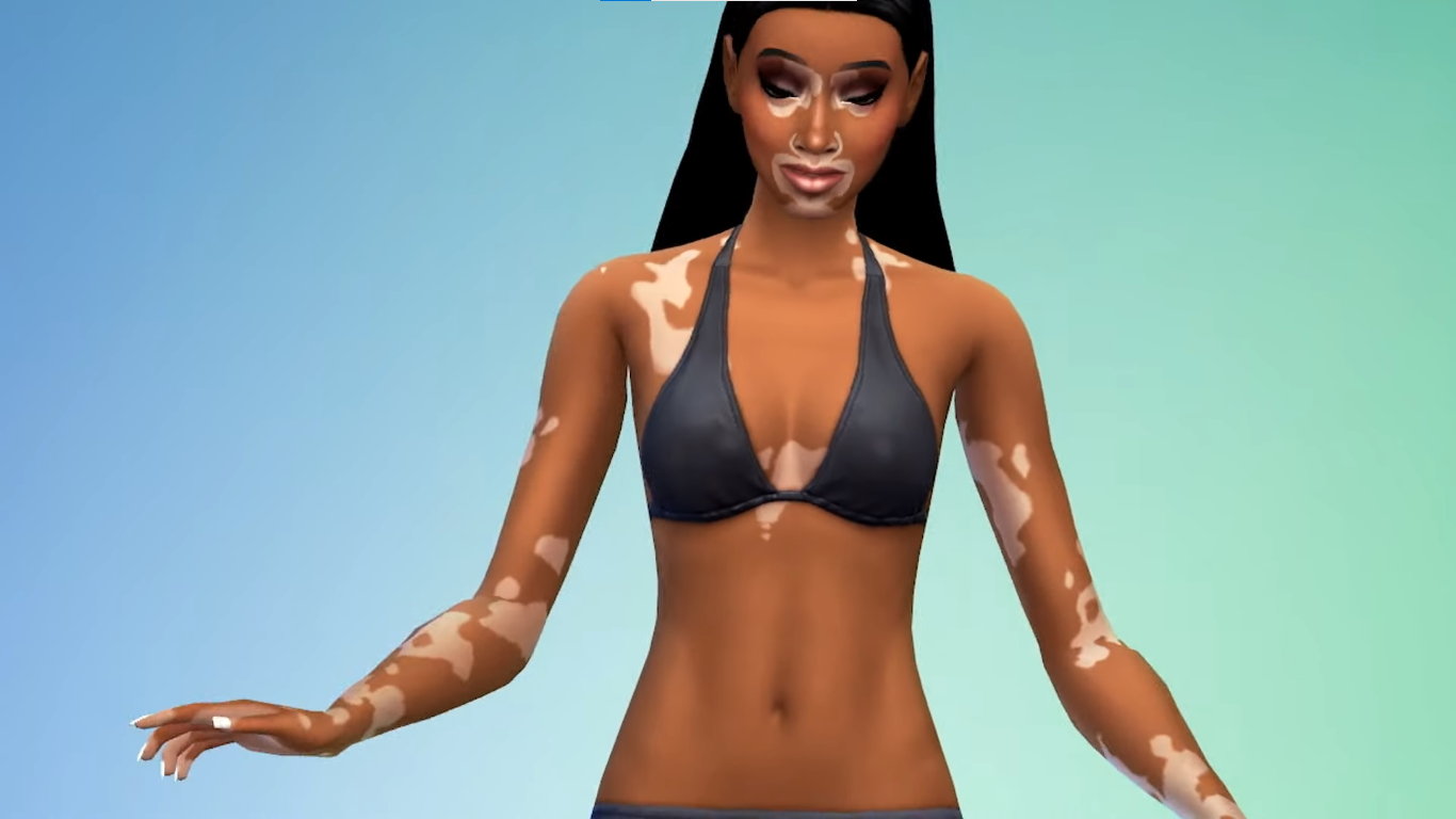 Vitiligo The Sims 4